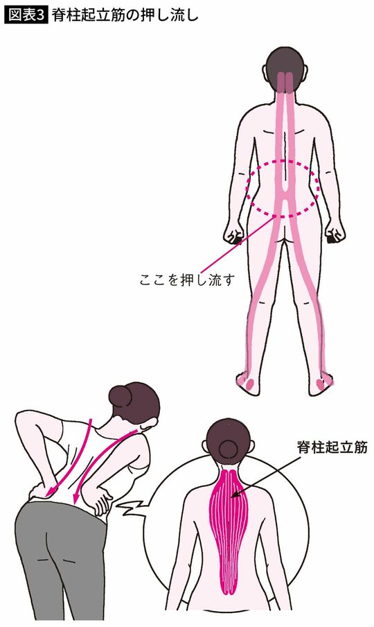 脊柱起立筋の押し流し