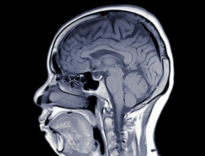 頭部のMRI画像