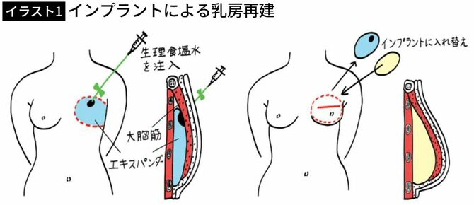 【イラスト】インプラントによる乳房再建