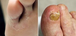 皮 親指 足 むける の が 足の親指の指紋に沿って皮膚がささくれて困っています。