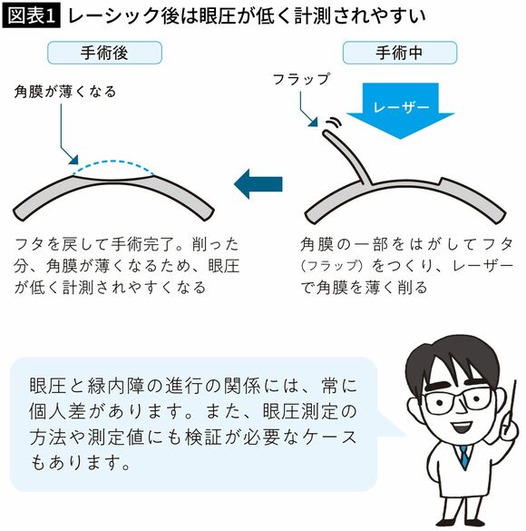 【図表1】レーシック後は眼圧が低く計測されやすい