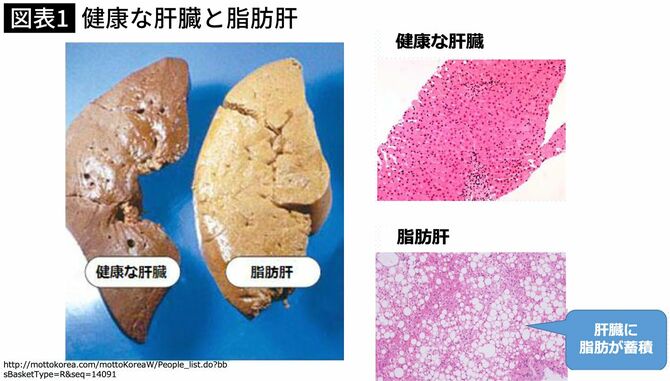 【図表】健康な肝臓と脂肪肝