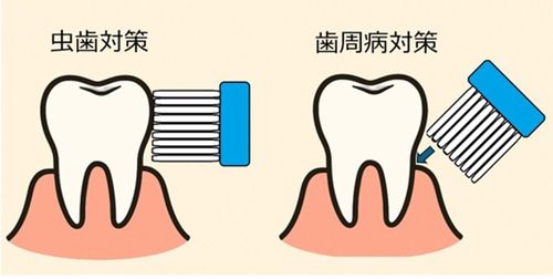 虫歯対策と歯周病対策のブラッシングの違い