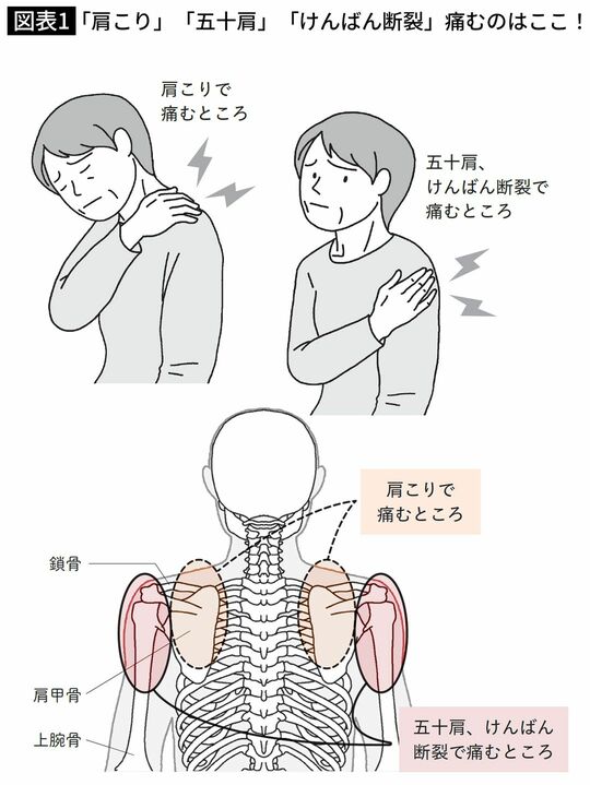 「肩こり」「五十肩」「けんばん断裂」痛むのはここ！