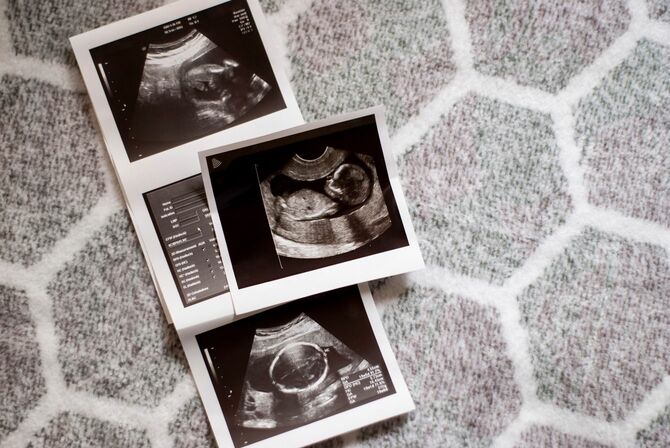 胎児の超音波写真